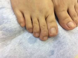-德哥灰指甲脚气甲沟炎跖疣护理