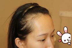 -大麦微针植发丨全国连锁