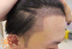 -大麦微针植发丨全国连锁