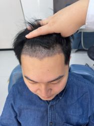 -大麦微针植发全国连锁