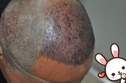 -大麦微针植发丨全国连锁