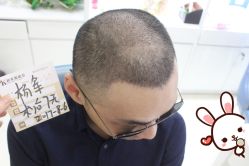 -大麦微针植发丨全国连锁