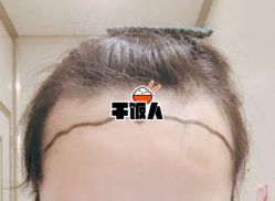 -大麦微针植发全国连锁