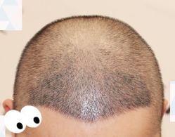 -大麦微针植发全国连锁