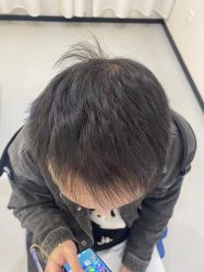 -大麦微针植发全国连锁