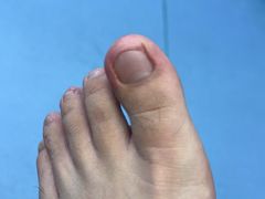 -Andrew指甲专科灰指甲·甲沟炎矫正·3D步态矫形鞋垫定制(浦三路店)