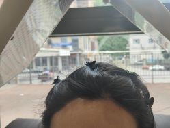 -碧莲盛·不剃发植发