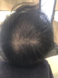 点击看大图 -大麦微针植发丨全国连锁