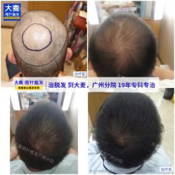 -大麦微针植发全国连锁