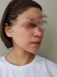 体验后-成都军建医院·疤痕诊疗中心