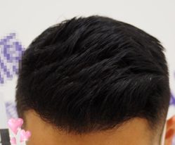 -大麦微针植发全国连锁