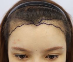 -大麦微针植发全国连锁