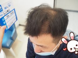 -大麦微针植发丨全国连锁