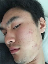 这是治疗前-痘博士重庆·全国连锁祛痘机构