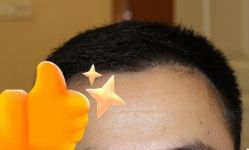 -大麦微针植发丨全国连锁