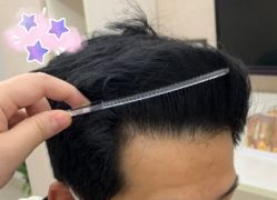 -大麦微针植发丨全国连锁