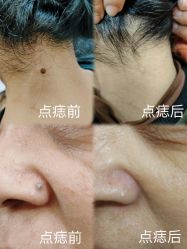 -北京美痣堂古方祛痣斑疣瘊