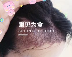 -大麦微针植发全国连锁