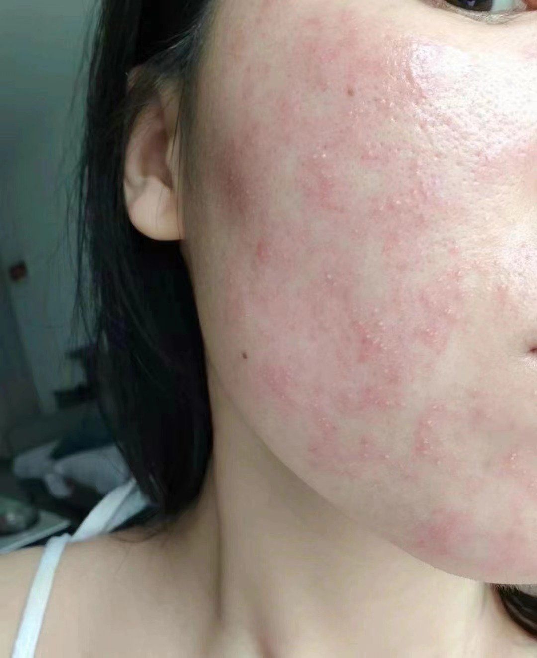 最近真的看到很多"烂脸"
39,59