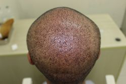 点击看大图 -大麦微针植发丨全国连锁