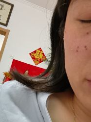 -北京美痣堂古方祛痣斑疣瘊