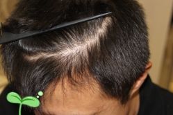 -大麦微针植发丨全国连锁