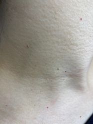-爱莎扁平疣·汗管瘤·斑痣中心