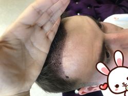 -大麦微针植发丨全国连锁