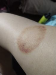 -莲芸拔罐减肥