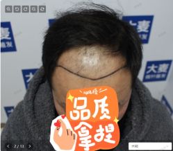 -大麦微针植发丨全国连锁