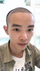 点击看大图 -大麦微针植发丨全国连锁