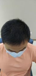 -大麦微针植发丨全国连锁