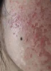 -痘庄科学祛痘国际连锁