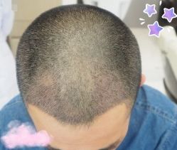 -大麦微针植发丨全国连锁