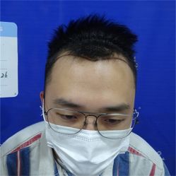 点击看大图 -碧莲盛·不剃发植发