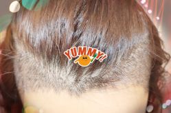 -大麦微针植发全国连锁