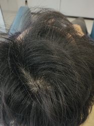 点击看大图 -大麦微针植发丨全国连锁