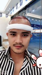 点击看大图 -大麦微针植发丨全国连锁