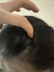 -碧莲盛·不剃发植发