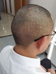 -大麦微针植发全国连锁