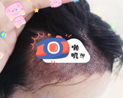 -大麦微针植发全国连锁