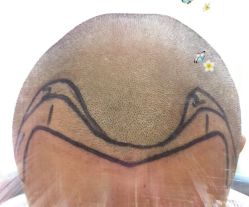 -大麦微针植发全国连锁