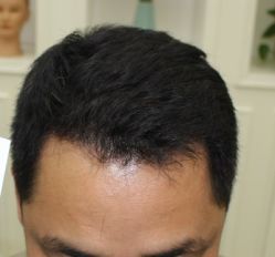 -大麦微针植发全国连锁