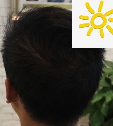 -大麦微针植发丨全国连锁