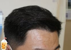 -大麦微针植发丨全国连锁