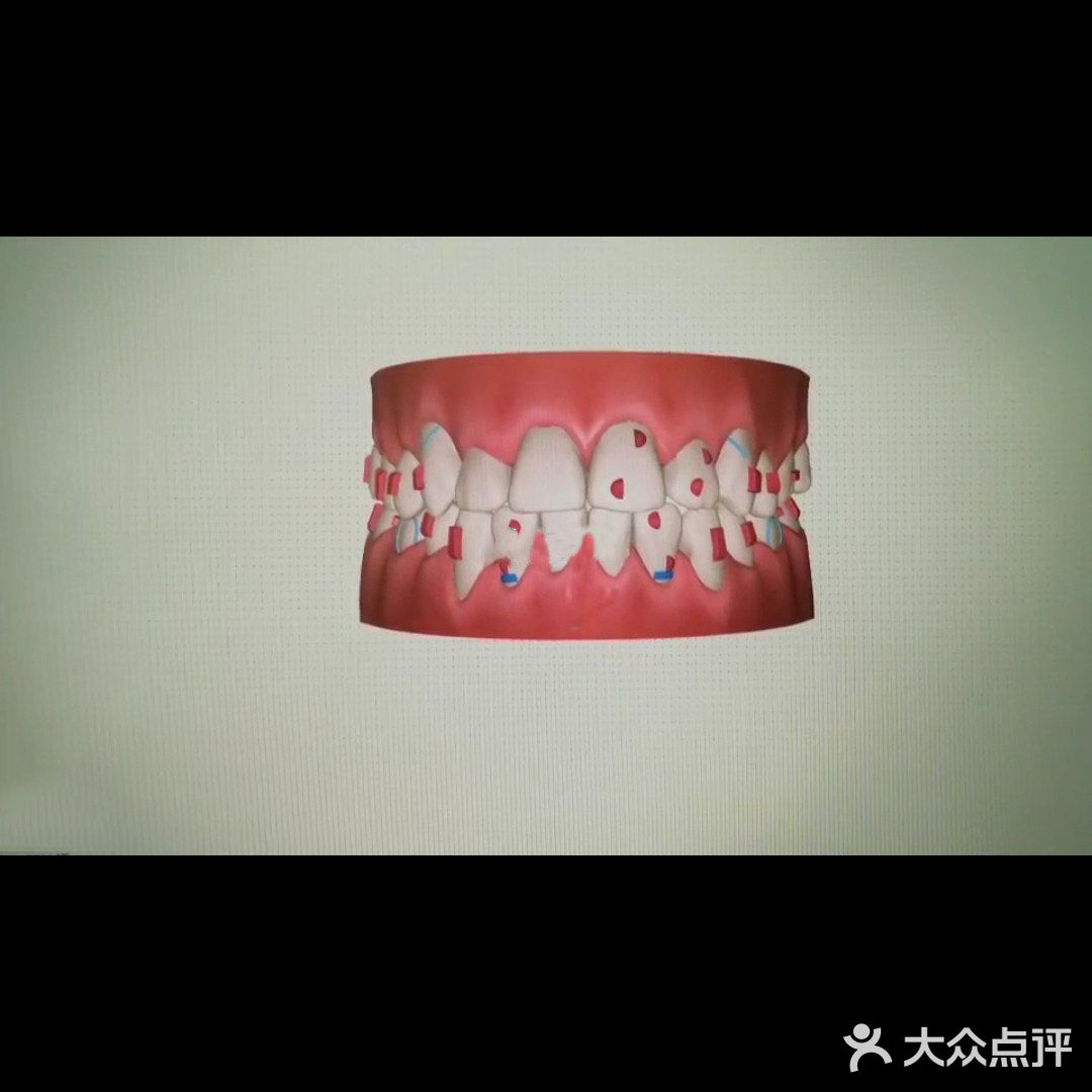 牙套日记|时代天使隐形矫正双模冠军