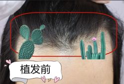 -大麦微针植发全国连锁