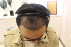 -大麦微针植发丨全国连锁
