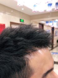 -碧莲盛·不剃发植发