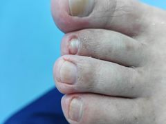 -Andrew指甲专科灰指甲·甲沟炎矫正·3D步态矫形鞋垫定制(浦三路店)